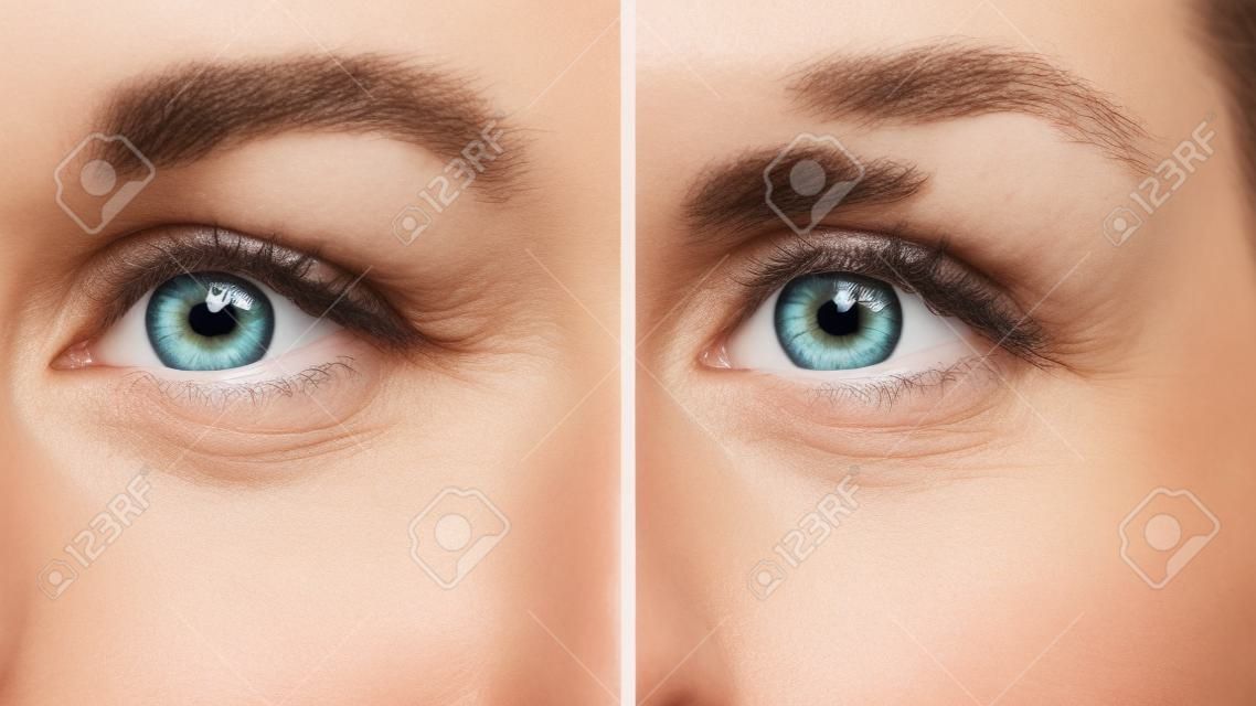 Gesicht der Frau, Augenfalten vor und nach der Behandlung - das Ergebnis verjüngender kosmetischer Verfahren zur Biorevitalisierung, Botox und Entfernung von Pigmentflecken.