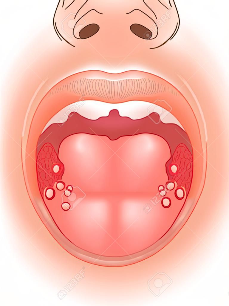 口舌生瘡