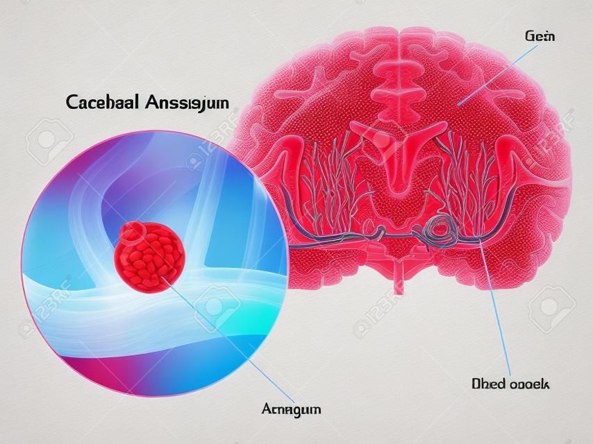 cerebral aneurysm