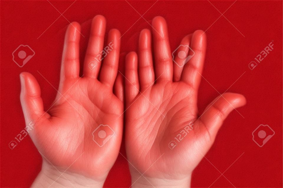 atopic dermatitis, Strong allergic eczema on hands. Red, cracked skin with blisters