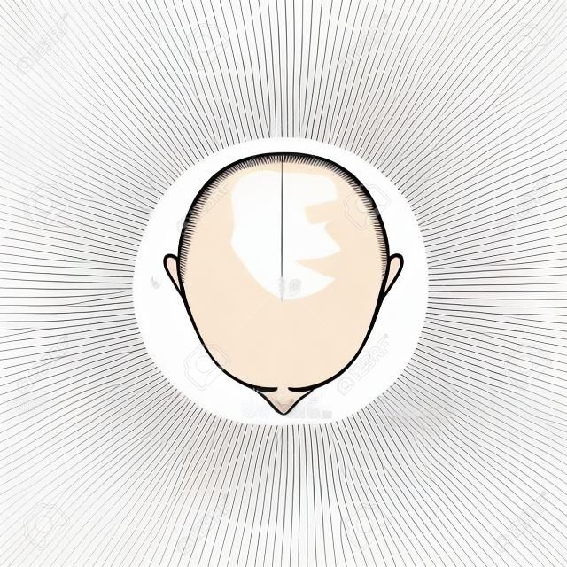 Top view of male bald head cartoon style, vector illustration isolated on white background. Men's hairless scalp, last stage of hair loss or alopecia, bald headed clipping