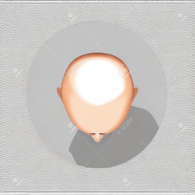 Vista superior del estilo de dibujos animados de cabeza calva masculina, ilustración vectorial aislado sobre fondo blanco. Cuero cabelludo sin pelo de los hombres, última etapa de la caída del cabello o alopecia, recorte de la cabeza calva