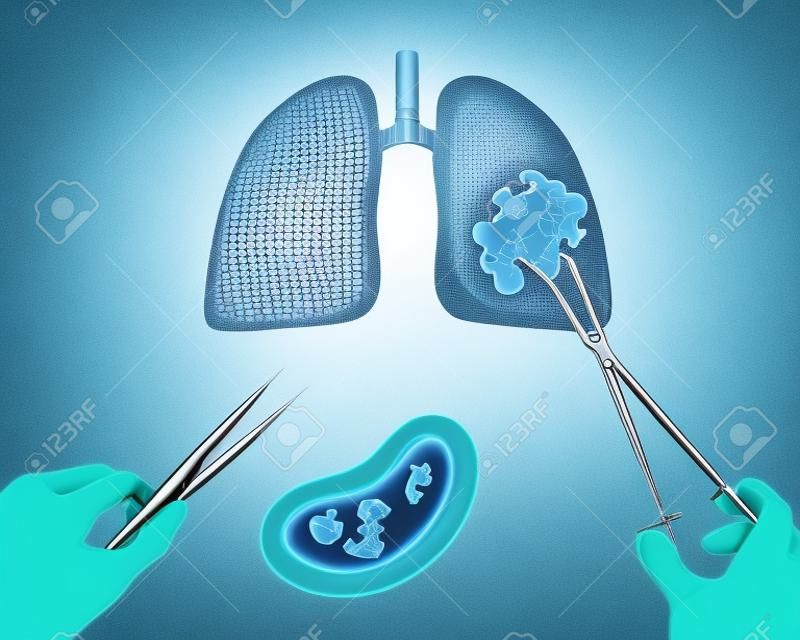 Lungs cancer operation oncotomy puzzle concept: hands of surgeon with surgical instruments (tools) performs surgery to remove cancerous growth (malignant swelling or benign tumor)