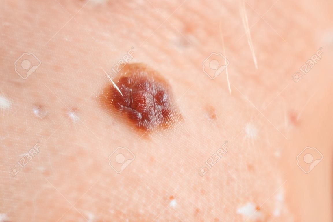 Birthmark on the skin of a person. Macro