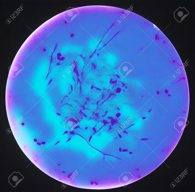 Esfregaço de sangue humano cultivado Gram's manchado sob microscópio de luz 100x com hifas e células de levedura