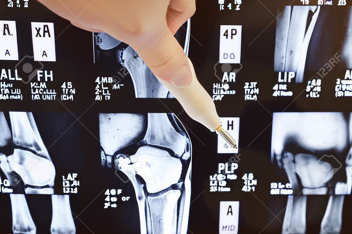 Radiografia dell'articolazione del ginocchio o risonanza magnetica. Il medico ha indicato l'area dell'articolazione del ginocchio, in cui è stata rilevata patologia o problema, come frattura, distruzione dell'articolazione, artrosi. Diagnosi delle malattie del ginocchio mediante radiologia