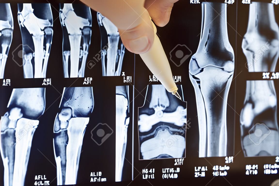 Knee joint x-ray or MRI. Doctor pointed on area of knee joint, where pathology or problem is detected, such fracture, destruction of joint, osteoarthritis. Diagnosis of knee diseases by radiology
