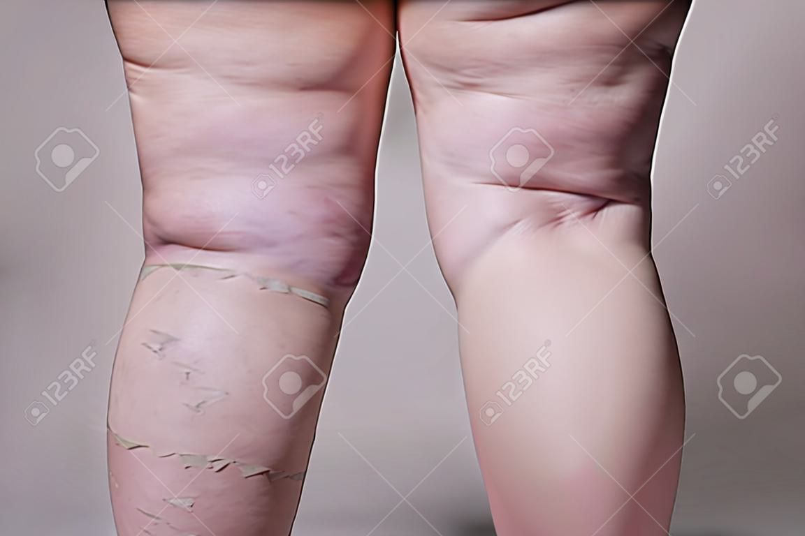 Veias varicosas closeup, pernas de celulite feminina gordas em um fundo cinza