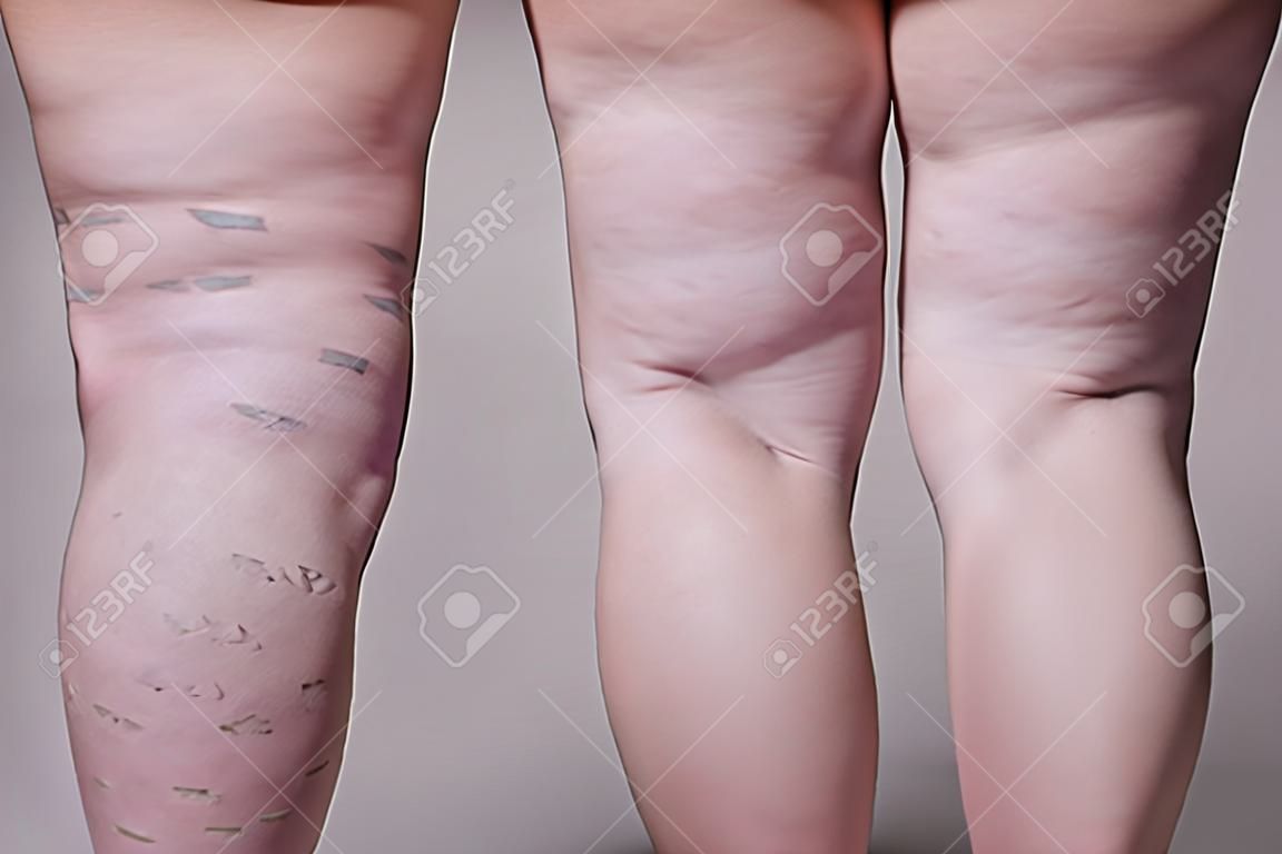 Veias varicosas closeup, pernas de celulite feminina gordas em um fundo cinza