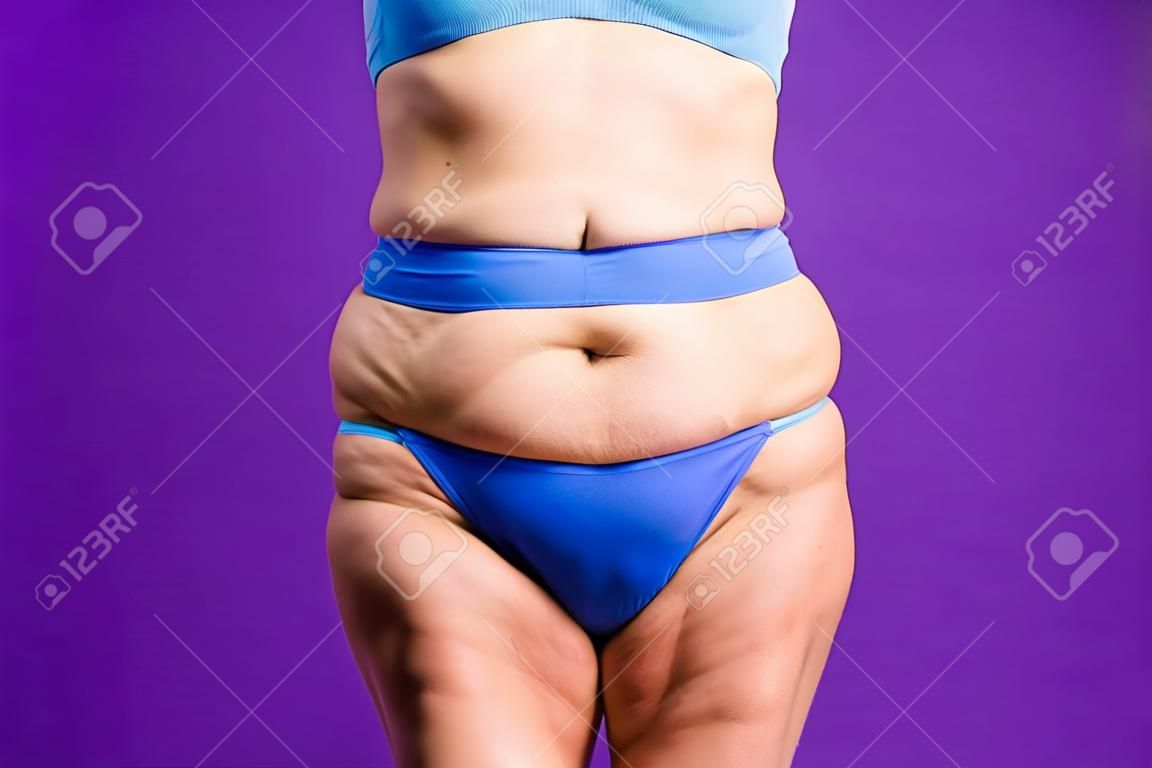 Bauchstraffung, schlaffe Haut auf einem dicken Bauch, Konzept der plastischen Chirurgie auf violettem Hintergrund
