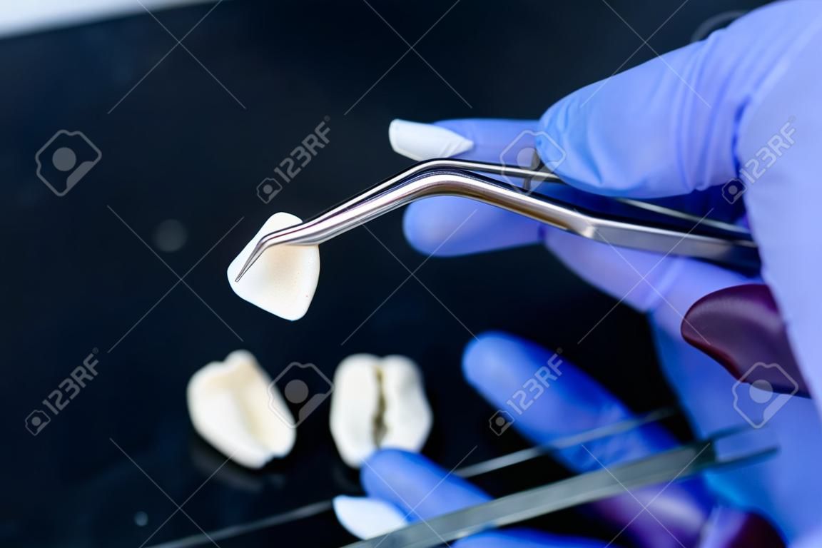 Um dentista está segurando pinças para folheados de cerâmica dentária e coroas. Closeup mão em luva azul