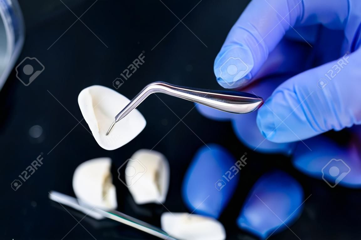 Un dentista tiene in mano le pinzette per le faccette e le corone in ceramica dentale. Mano del primo piano nel guanto blu