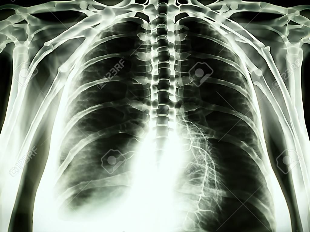 Фильм рентген грудной клетки PA вертикально-шоу плеврит на правом легком в связи с раком легких