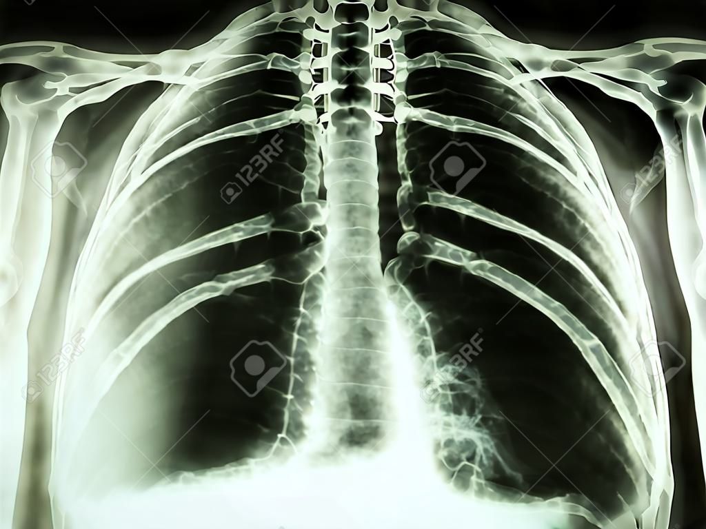 Film radiographie PA debout spectacle épanchement pleural au poumon droit due au cancer du poumon