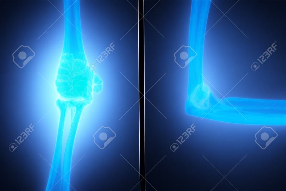 film x-ray elbow AP Lateral   normal human