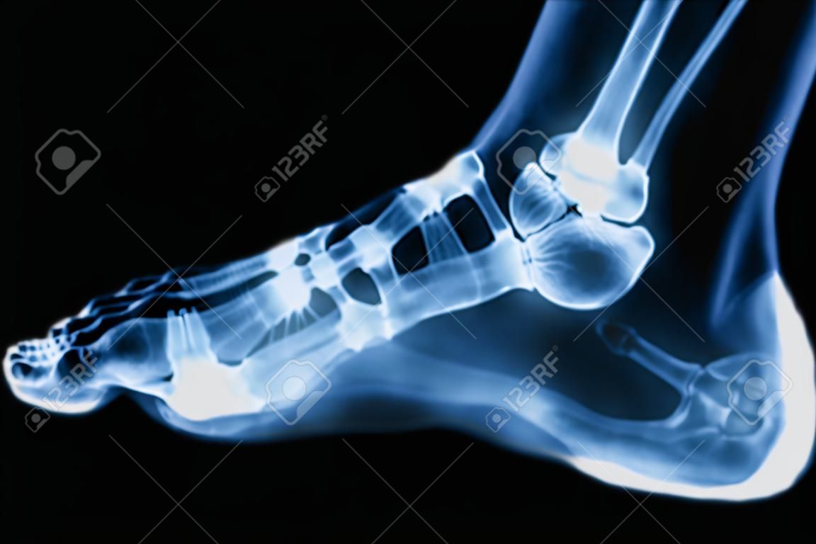 X-Ray нормально боковая ноги