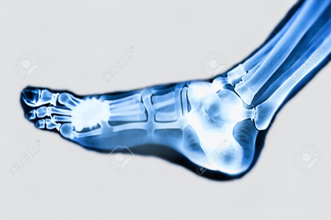 X-Ray нормально боковая ноги