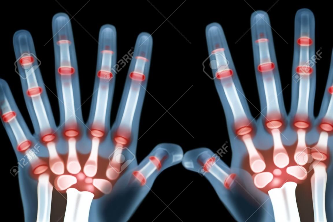 Rheumatoid arthritis ( X-ray both child hands and multiple joint arthritis )