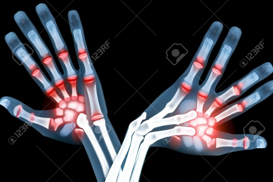 Rheumatoid arthritis ( X-ray both child hands and multiple joint arthritis )