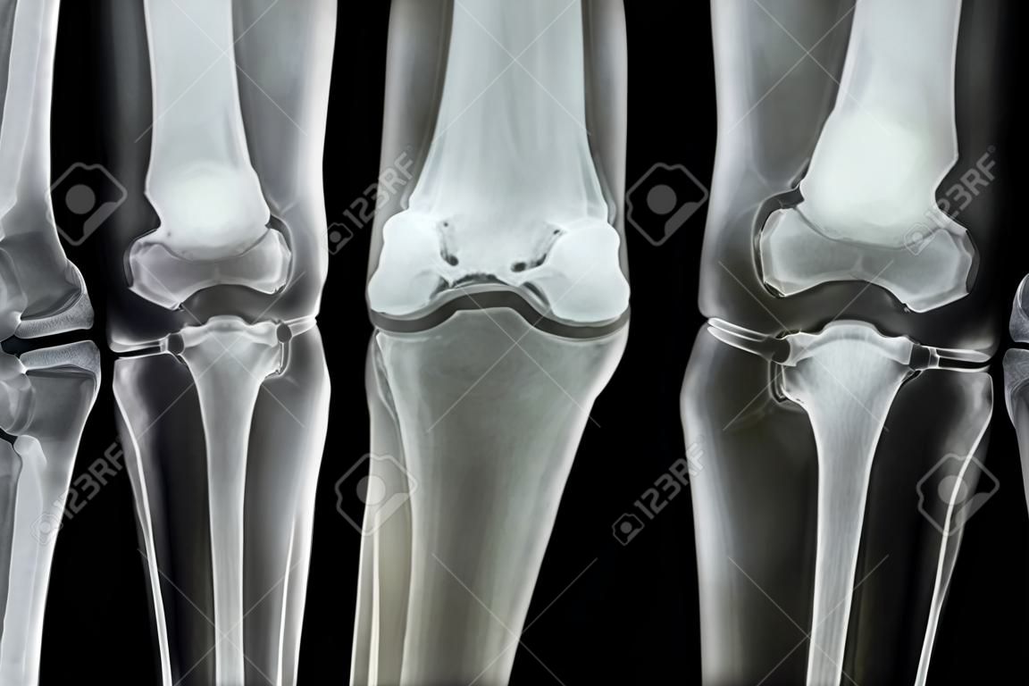 膝關節骨性關節炎（OA膝關節）。膜的X射線兩膝關節（主視圖）示出了窄關節間隙（關節軟骨損失），骨贅，軟骨下硬化