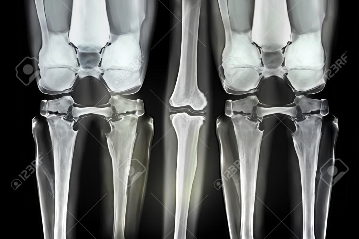 膝關節骨性關節炎（OA膝關節）。膜的X射線兩膝關節（主視圖）示出了窄關節間隙（關節軟骨損失），骨贅，軟骨下硬化