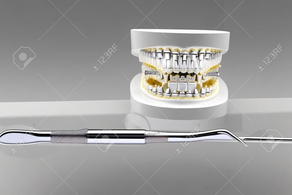 ortodontik model ve diş hekimliği aracı - ortodontik ayraç veya parantez çeşitlerinin demonstrasyon diş modelleri
