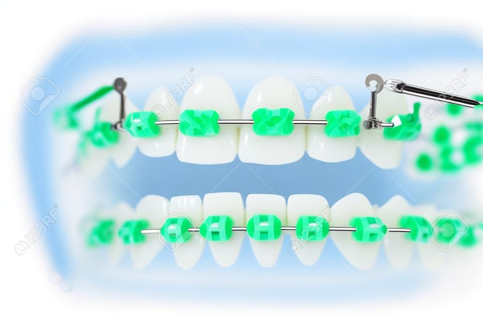 orthodontische model en tandarts gereedschap - demonstratie tanden model van varities van orthodontische beugel of brace