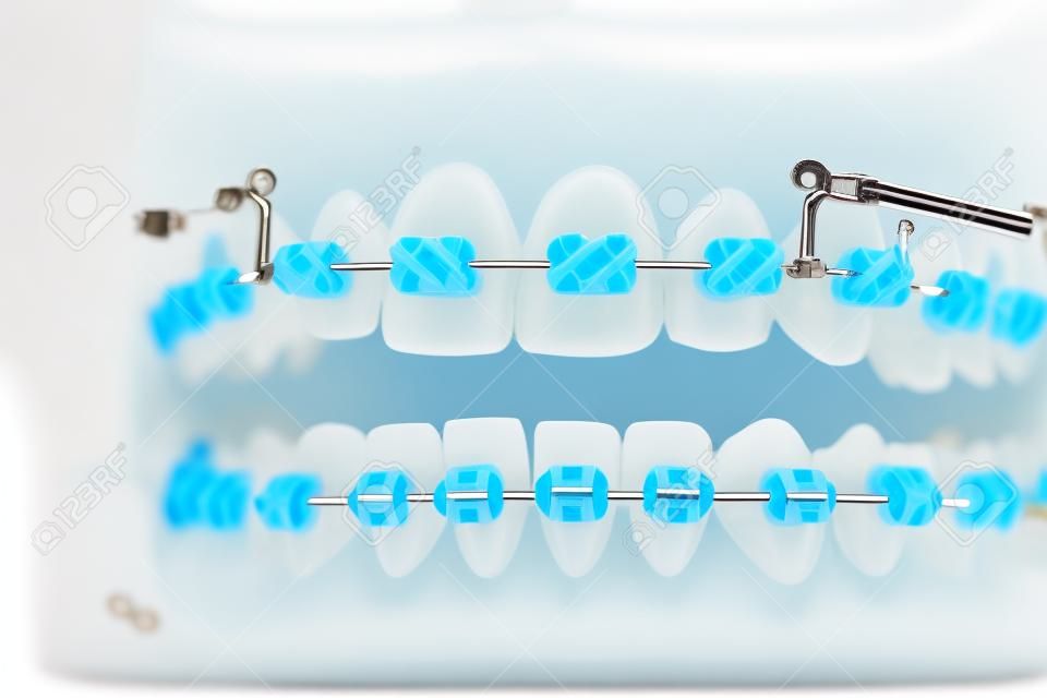 orthodontische model en tandarts gereedschap - demonstratie tanden model van varities van orthodontische beugel of brace