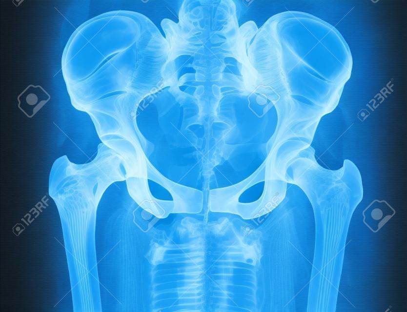 Röntgenfoto van het bekken en de wervelkolom van een vrouw