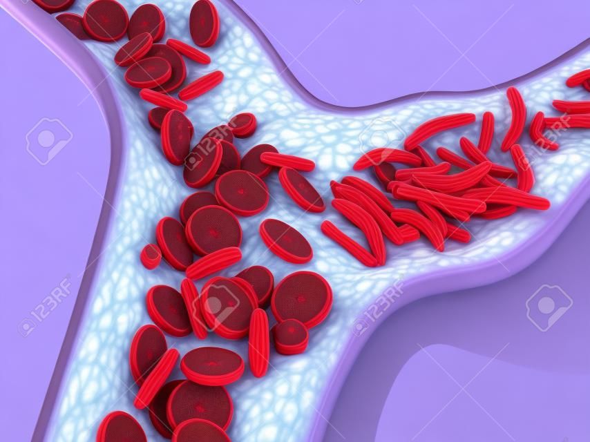 Anémie falciforme, illustration 3D montrant un vaisseau sanguin avec un croissant normal et déformé.