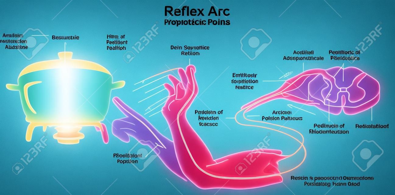Diagramme infographique de l'arc réflexe avec l'exemple de la main humaine réflexe polysynaptique touchant les récepteurs de la douleur à l'objet chaud et la direction de l'impulsion pour l'enseignement des sciences médicales