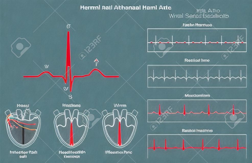 Normal and Abnormal Heart Rate infographic diagram including activation of atria ventricle and recovery wave also chart of normal fast slow irregular heartbeats for medical science education and health care