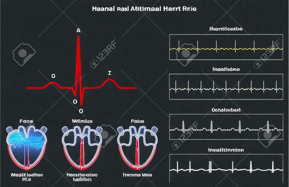 Normales und Abnormales Herzfrequenz-Infographiediagramm einschließlich Aktivierung von Vorhofventrikel und Erholungswelle Auch Diagramm der normalen schnellen langsamen Herzrhythmusstörungen für medizinische Ausbildung und Gesundheitswesen