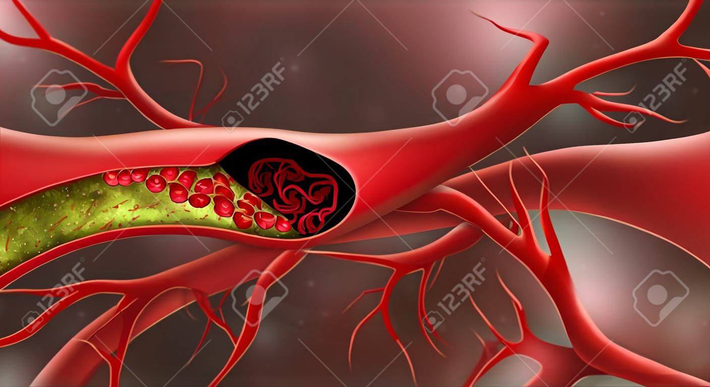 Artery blocked by cholesterol. Vector illustration