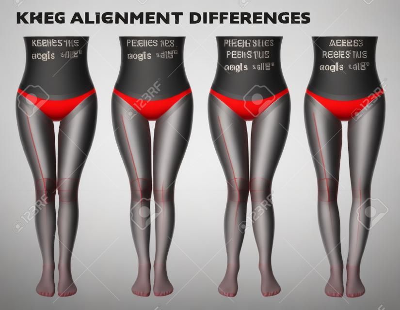 Legs and angles of the knees, different types of leg shapes. Front view girl, body anatomy. Normal varus and valgus