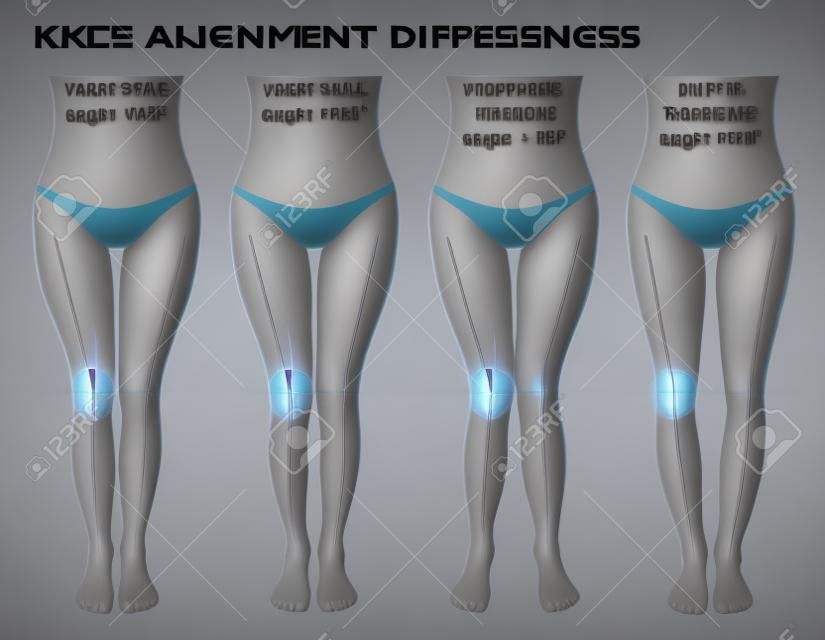 Gambe e angoli delle ginocchia, diversi tipi di forme delle gambe. Ragazza vista frontale, anatomia del corpo. Varo e valgo normali