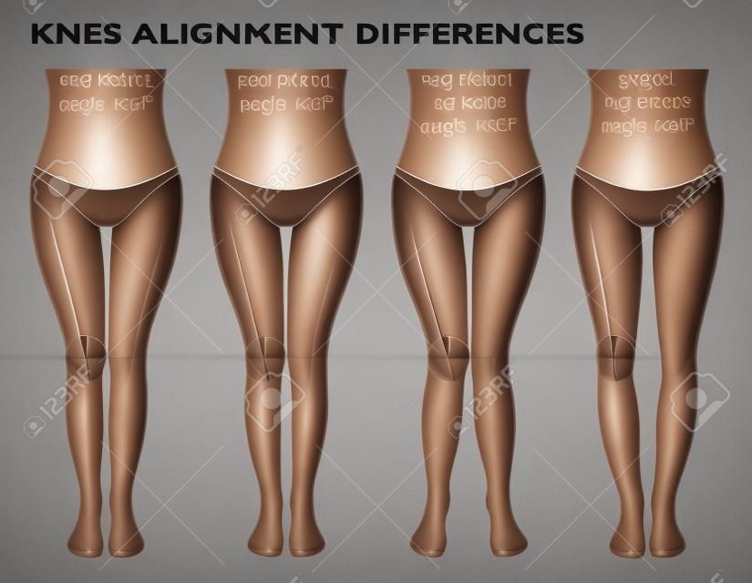 Piernas y ángulos de las rodillas, diferentes tipos de formas de piernas. Chica de vista frontal, anatomía del cuerpo. Varo y valgo normales