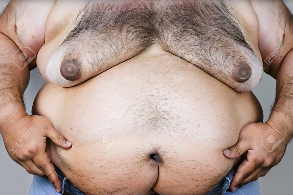 A fat man with a shaggy beard. Obese people. The Dangers of Belly Fat. Fat man with a big belly , Men at risk for diabetes. Obese people with diabetes.