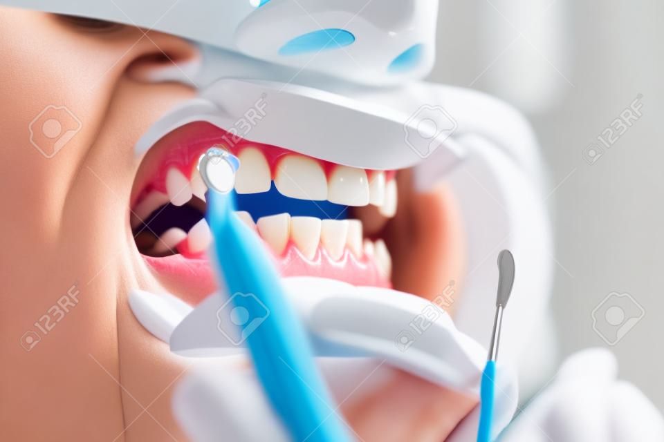 Nahaufnahmeporträt einer Patientin, die einen Zahnarzt zur Zahnaufhellung in der Klinik besucht, Zahnaufhellungsverfahren.