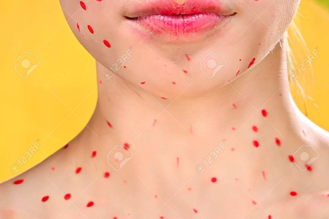 viso femminile vista ritagliata punti rossi sul viso problemi di pelle