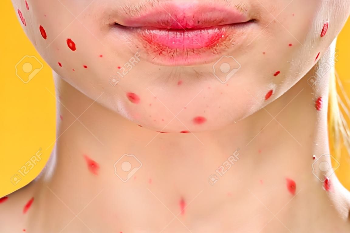 viso femminile vista ritagliata punti rossi sul viso problemi di pelle