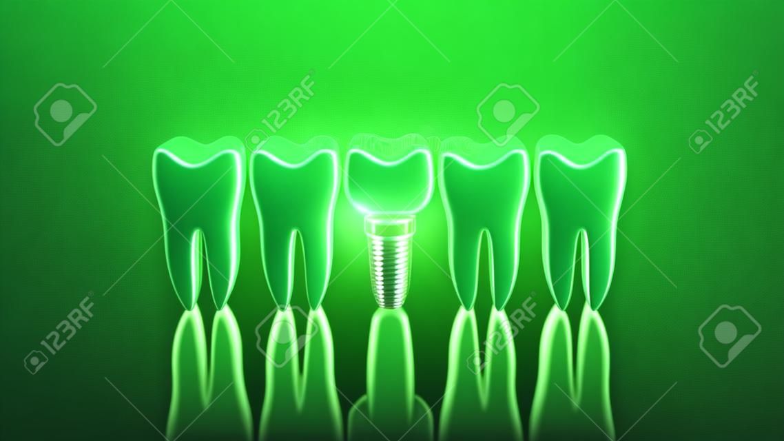 基于绿色背景三维插图的牙齿和牙种植体