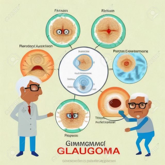 Симптомы глаукомы старика и подробная анатомия глаукомы и здорового глаза. Инфо-графика векторные иллюстрации