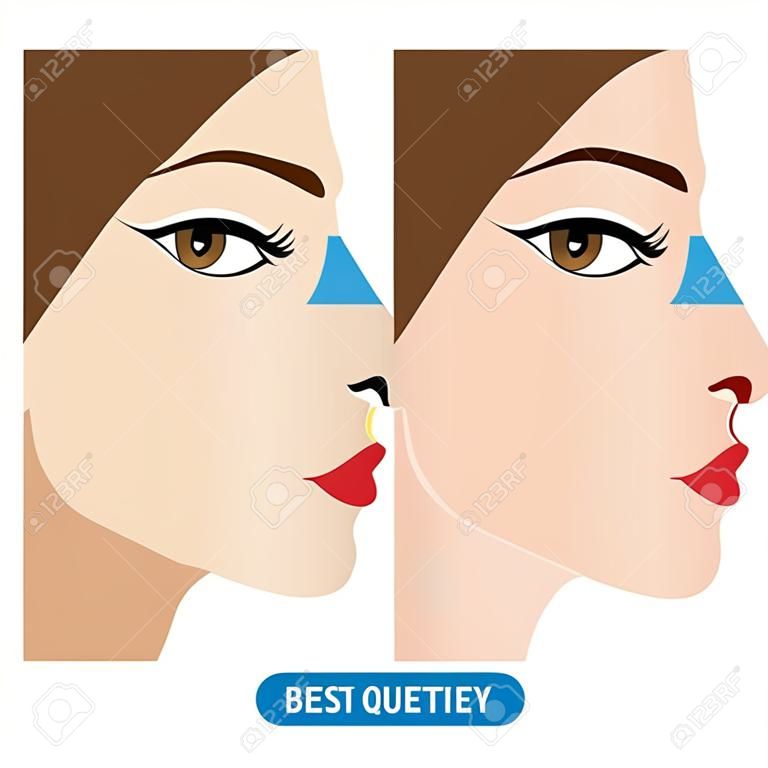 鼻子美容手術，隆鼻矢量圖