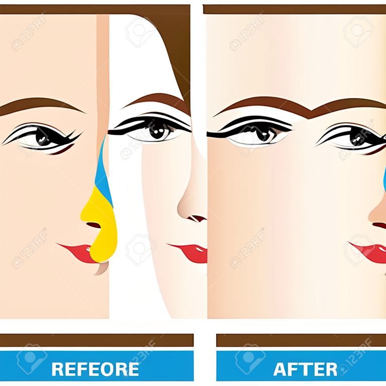 Nose beauty surgery , rhinoplasty vector illustration