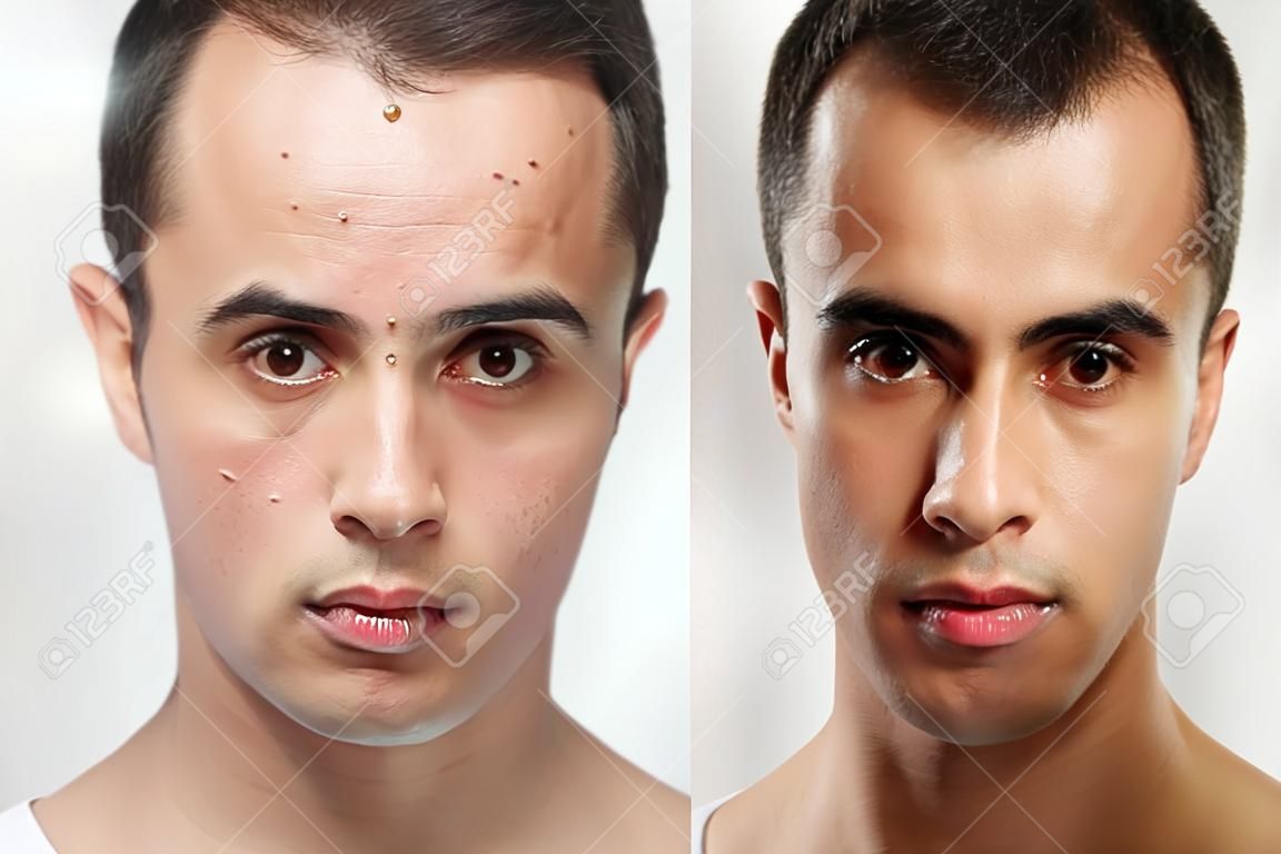 Avant et après la chirurgie esthétique. Jeune portrait de l'homme, isolé sur un fond blanc. Avant et après la procédure cosmétique ou en plastique, le traitement anti-âge, l'élimination de l'acné, la retouche. tourné en studio