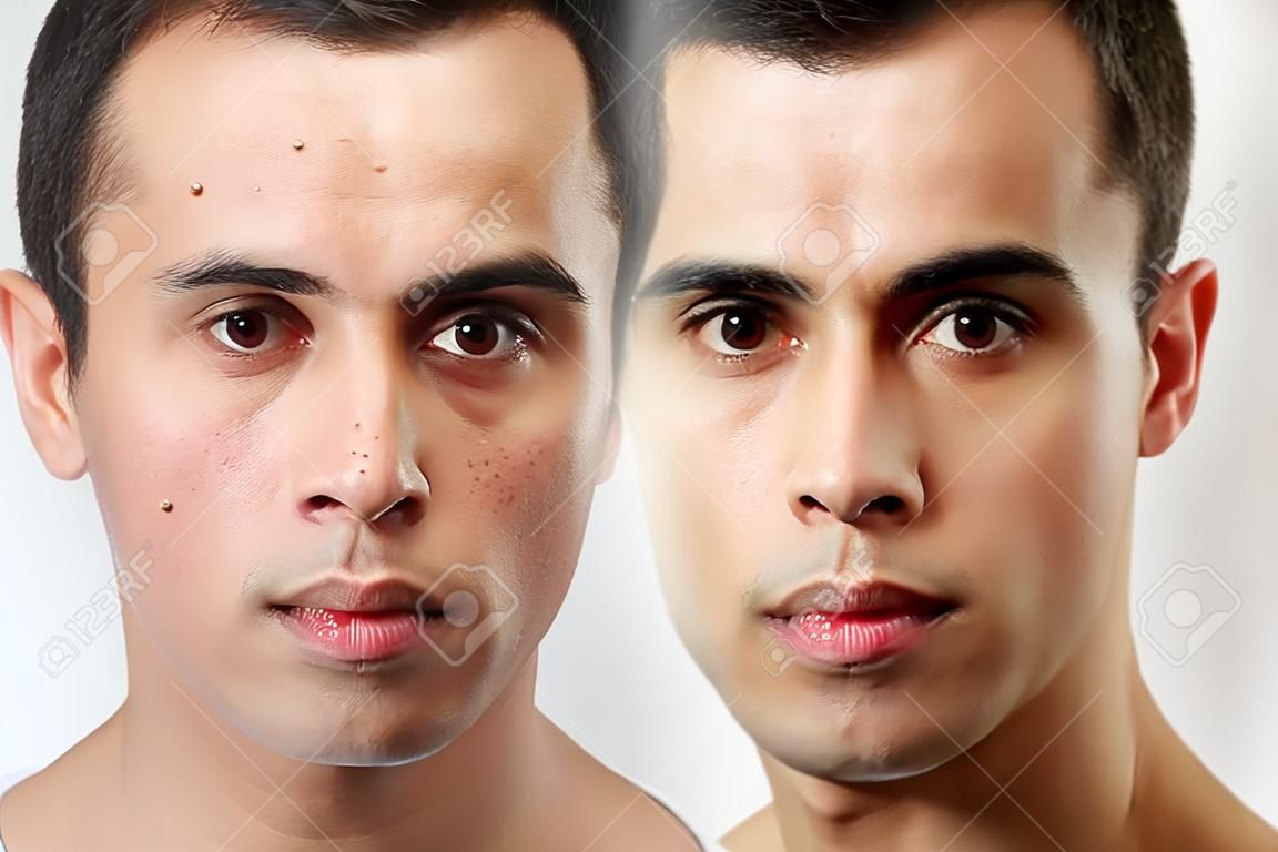 美容整形手術の前後後で。若い男の肖像画、白い背景で隔離。前に、化粧品やプラスチックの手順の後、反時代の治療、にきびの除去はレタッチ。スタジオ撮影