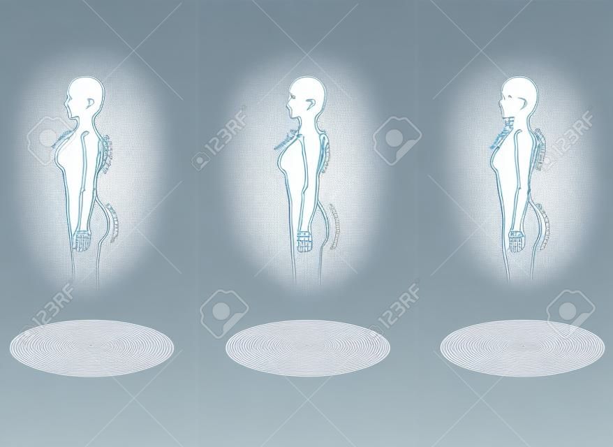 Diagnóstico Esquelético 3 tipos de ilustrações de forma corporal vistas do lado (onda reta natural)