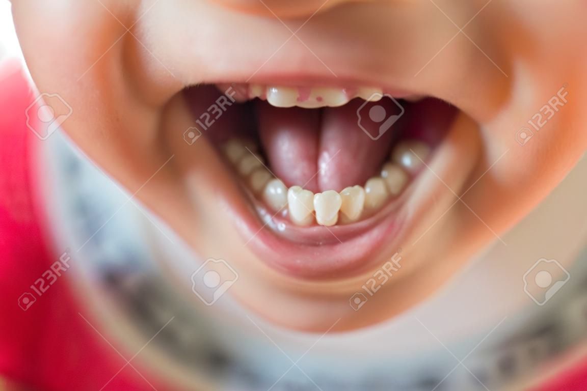 子供は乳歯を持っていました。選択的フォーカス。