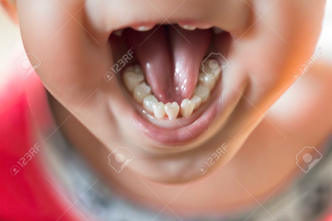 The kid had a baby tooth. Selective focus.